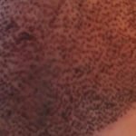 Qual a diferença entre as técnicas de transplante capilar (FUE e FUT)