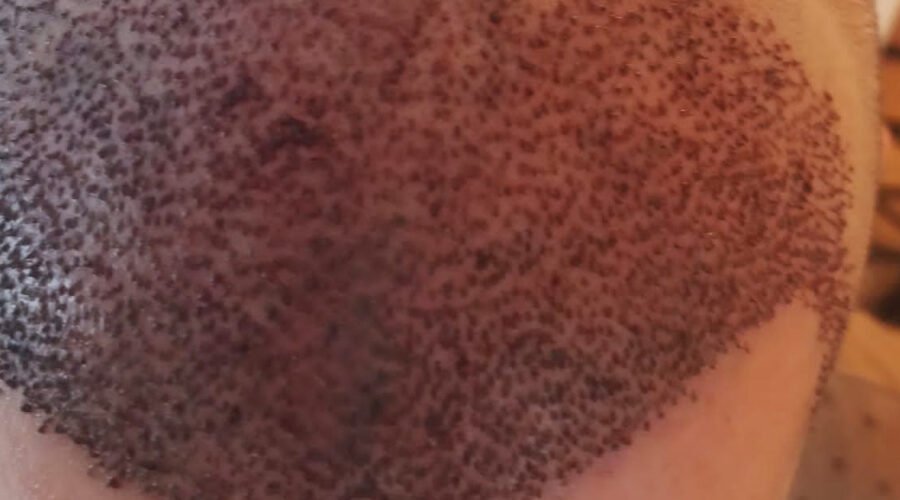 Qual a diferença entre as técnicas de transplante capilar (FUE e FUT)