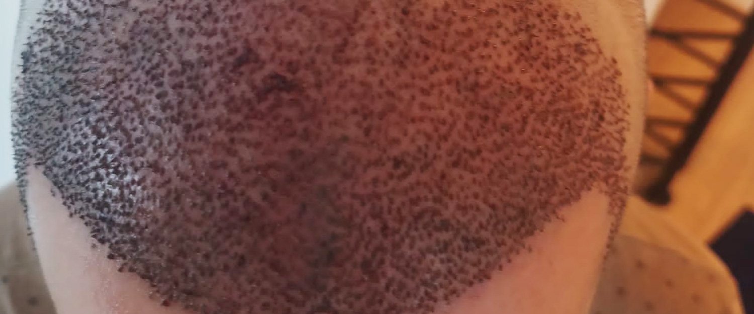 Qual a diferença entre as técnicas de transplante capilar (FUE e FUT)