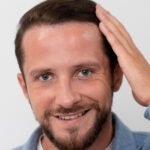 Transplante capilar é definitivo O que acontece com os fios ao longo do tempo