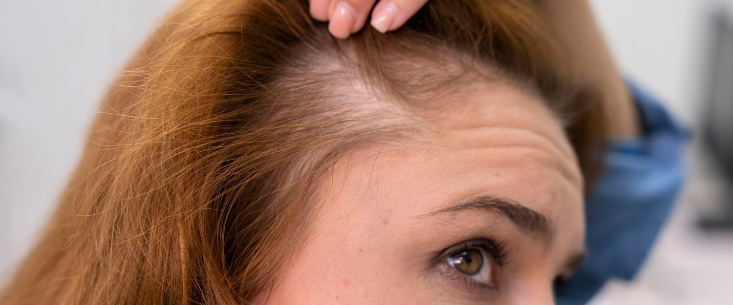 Quando o transplante capilar é indicado para casos de alopecia androgenética